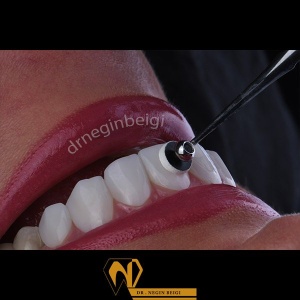 smile-design-11