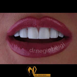 smile-design-12