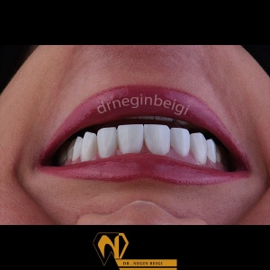 smile-design-7