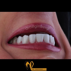smile-design-8