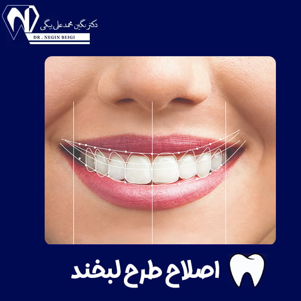 اصلاح طرح لبخند - دکتر نگین محمد علی بیگی