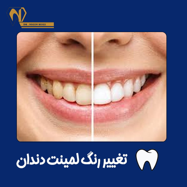 تغییر رنگ لمینت دندان - دکتر نگین محمد علی بیگی