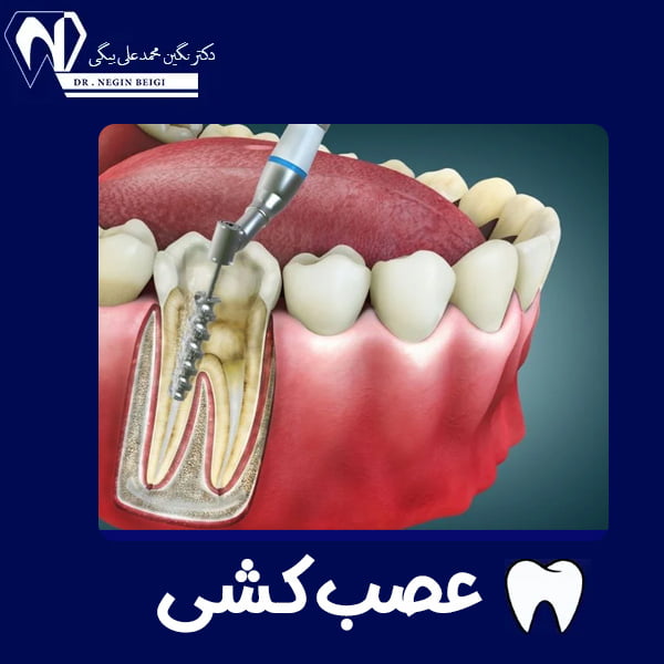 عصب کشی دندان درد دارد ؟ - دکتر نگین محمد علی بیگی