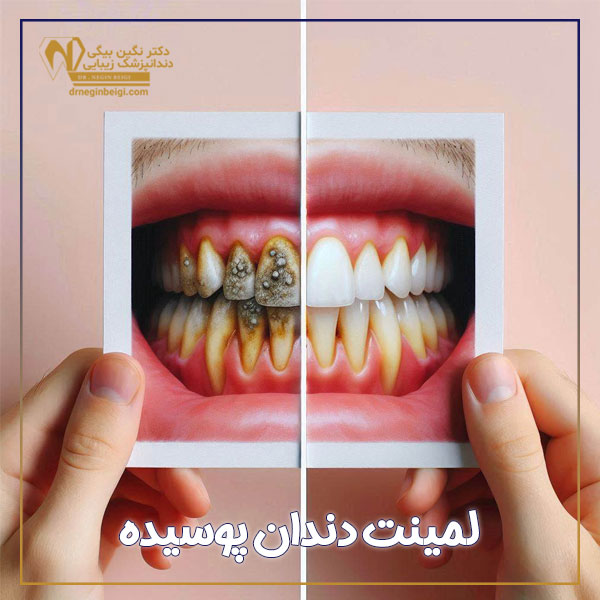 لمینت دندان پوسیده + دکتر نگین محمد علی بیگی