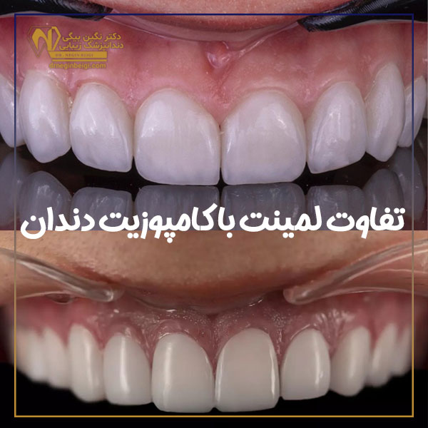تفاوت لمینت دندان با کامپوزیت دندان + دکتر نگین محمد علی بیگی