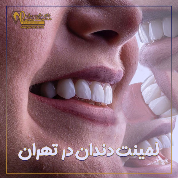 لمینت دندان در تهران - دکتر نگین محمد علی بیگی