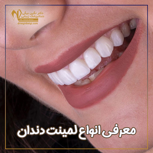 انواع لمینت دندان + دکتر نگین محمد علی بیگی