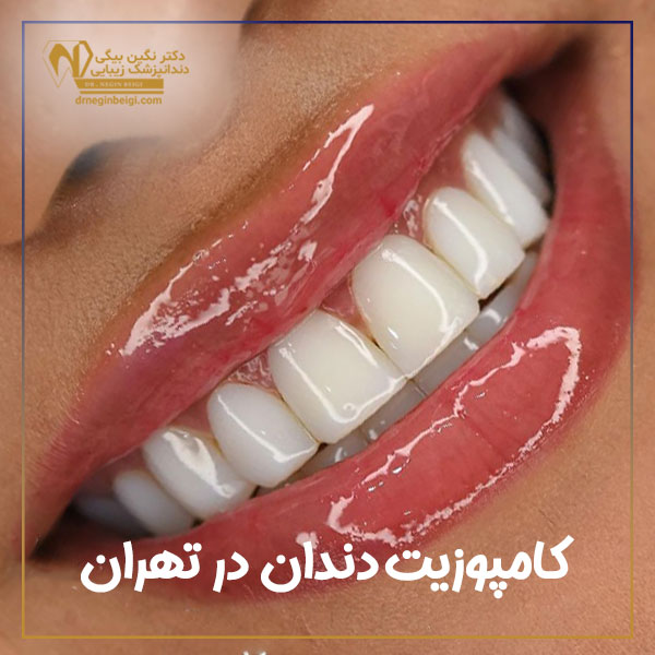 کامپوزیت دندان در تهران + دکتر نگین محمد علی بیگی