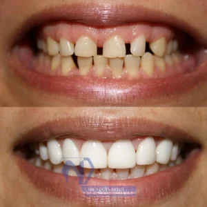 نمونه کار کامپوزیت دکتر نگین بیگی