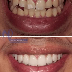 تصویر قبل و بعد از کامپوزیت دندان
