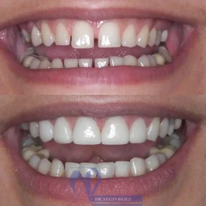 عکس قبل و بعد کامپوزیت دندان