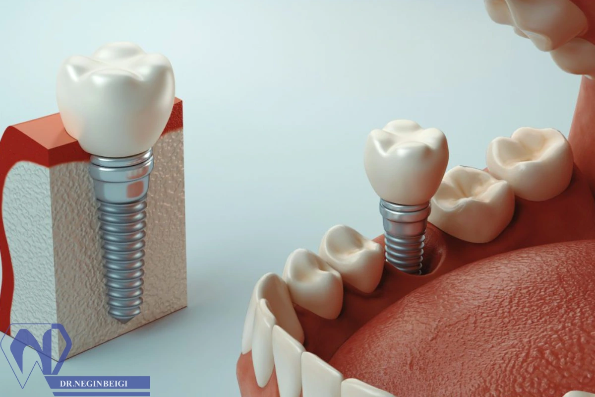 علت درد گرفتن دندان ایمپلنت شده