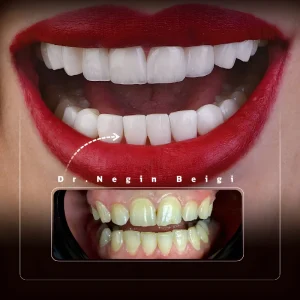 نمونه کار کامپوزیت دندان دکتر نگین بیگی