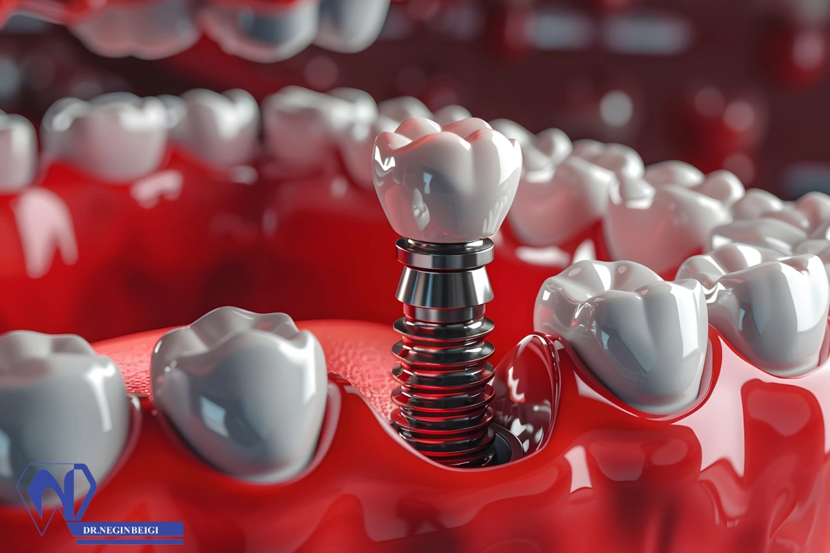 طول عمر ایمپلنت دندان چقدر است + عوامل تاثیر گذار