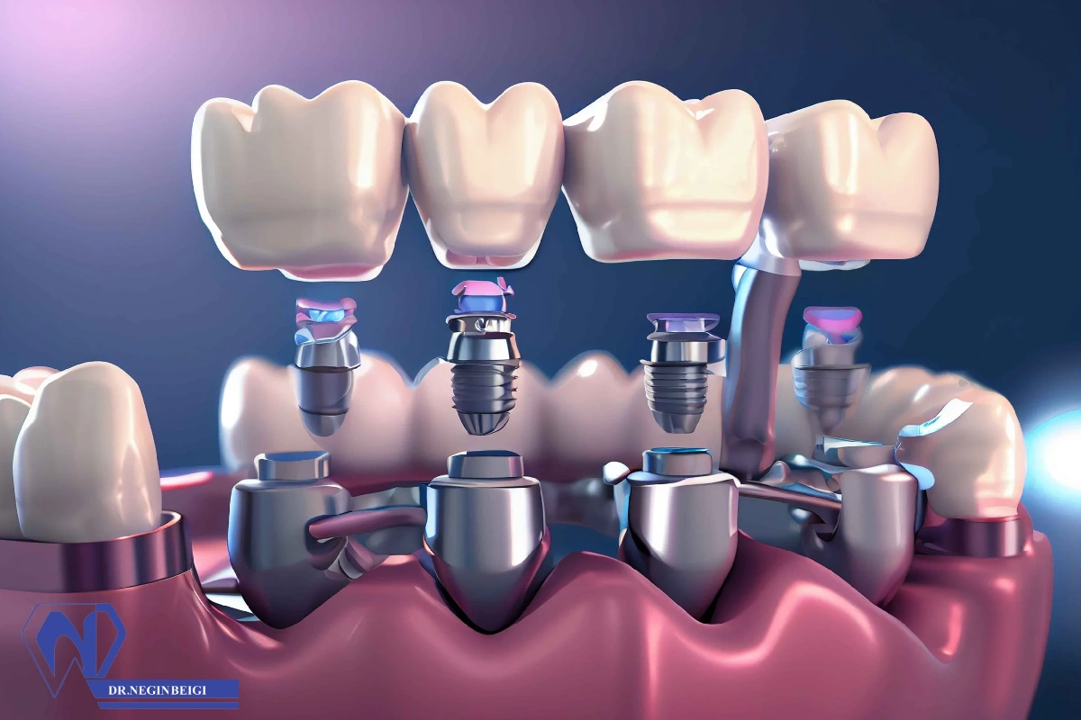 آیا ایمپلنت دندان عمری و مادامالعمر است؟